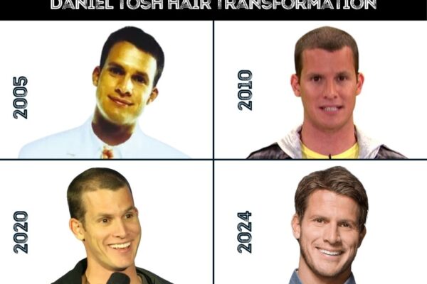 Daniel Tosh Hair Transplant - Hair Loss & Technical Analysis